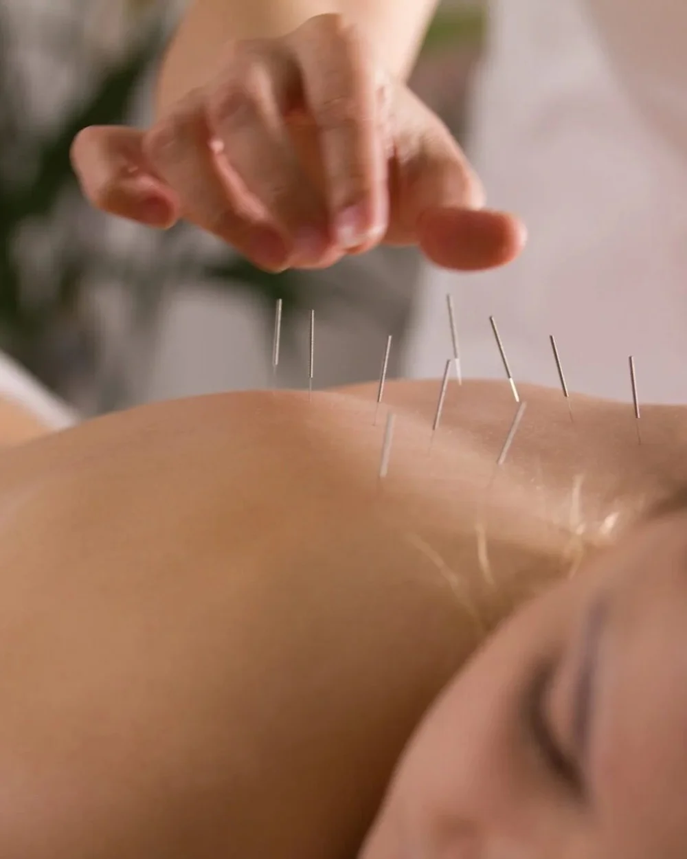 Acupuncture Therapy